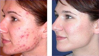 Fraxel Laser Clinic: acne scar laser treatment with fraxel lasers Sydney , Paddington, & Wahroonga