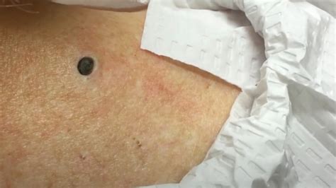 Dr. Pimple Popper's Best And Worst Cases