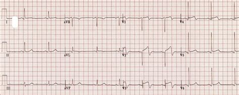 Wellens syndrome (웰렌 증후군) - a2