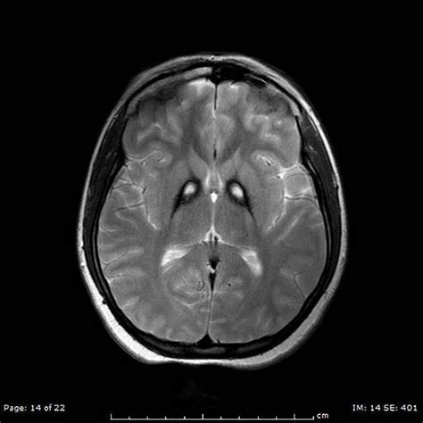 327 best images about MRI on Pinterest | High resolution images, 3t and White matter