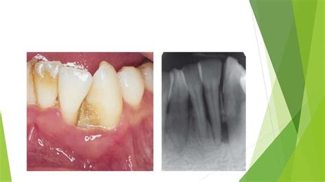 Necrotizing periodontal disease