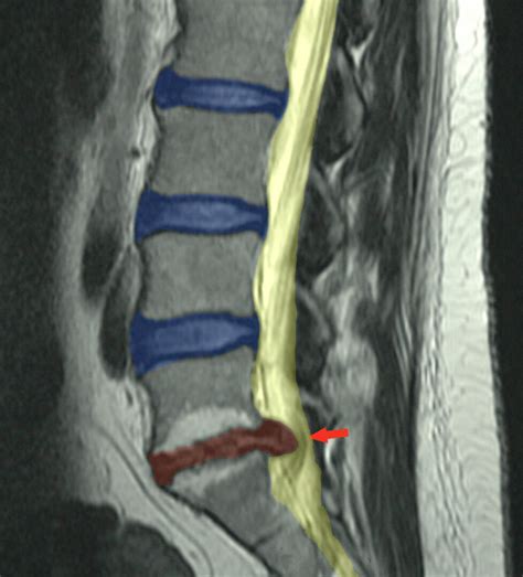 Lumbar Disc Herniation - Mark Nelson, M. D.