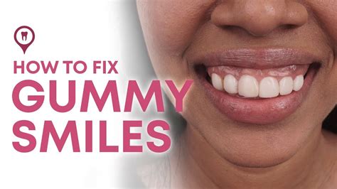 How To Solve A Gummy Smile - How To Fix A Gummy Smile Causes And Treatment Oasis Dental Studio ...