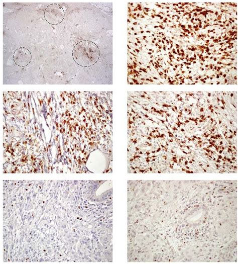 Immunohistochemical staining of tumor-infiltrating T lymphocytes. (A ...