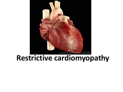 Restrictive cardiomyopathy