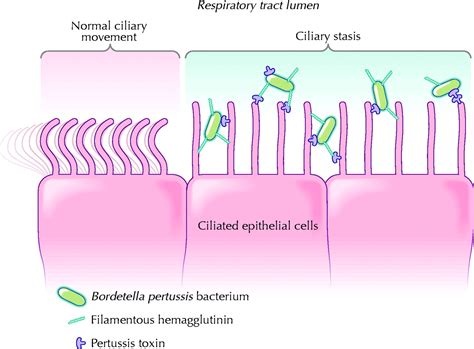 Diagnosis and management of pertussis | CMAJ