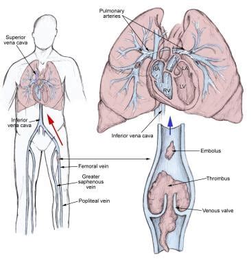 Pulmonary Embolism (PE): Practice Essentials, Background, Anatomy