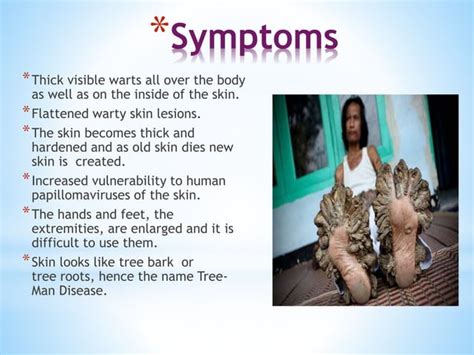 Tree-man disease (Epidermodysplasia Verruciformis)