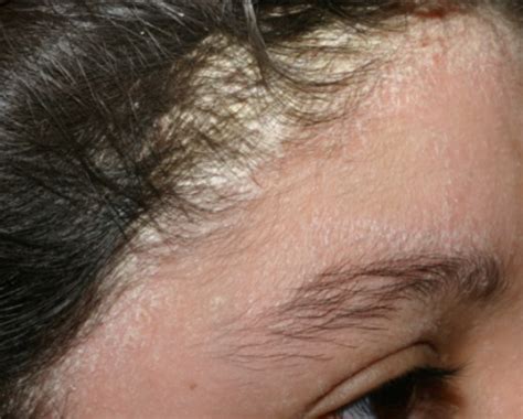 seborrheic dermatitis blog Vibrant Dermatology