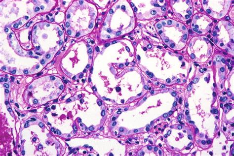 Acute Tubular Necrosis | Basicmedical Key