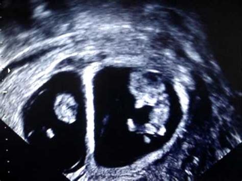 10 WEEKS TWIN PREGNANCY SCAN :) - YouTube