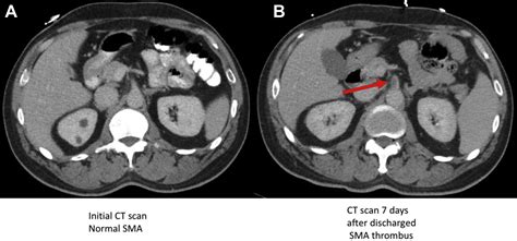 Acute superior mesenteric artery thrombosis seven days after discharge ...