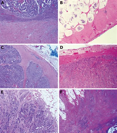 Subtypes of histologic growth pattern of primary colorectal carcinoma ...