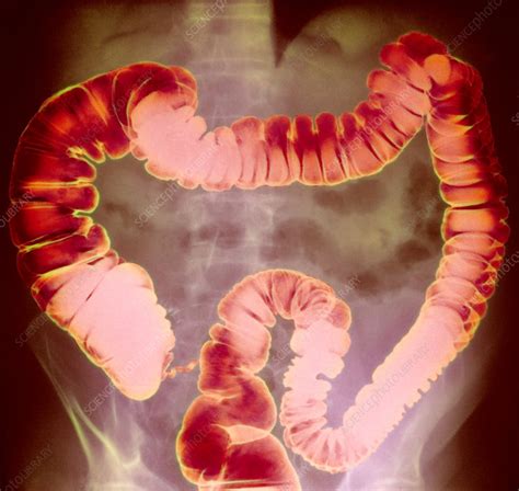 Large intestine, X-ray - Stock Image - P560/0147 - Science Photo Library