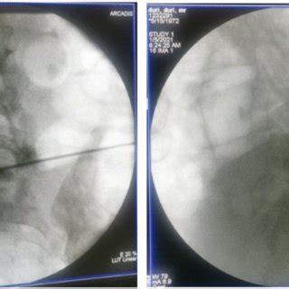 Contrast agent injection after final working zone was confirmed. | Download Scientific Diagram