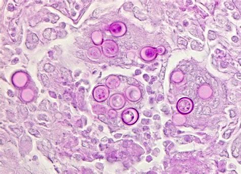 Blastomycosis Histology