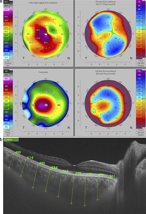 Corneal topography map from both right (grade II KC, a) and left eye ...