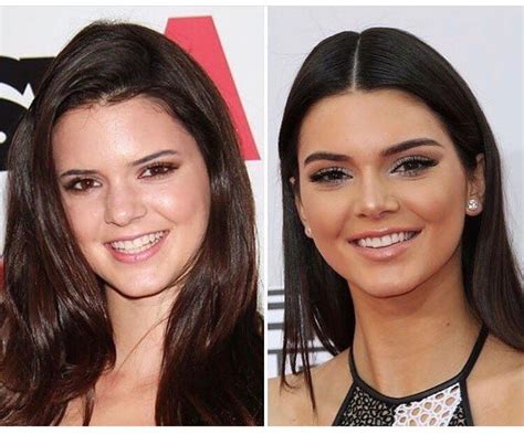 Kendall Jenner before and after | Kendall jenner nose job, Kendall jenner surgery, Kendall ...