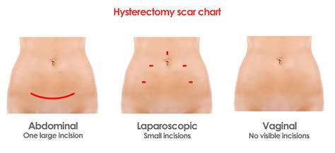 Pictures of Hysterectomy Scars and Incisions from Different Surgical ...