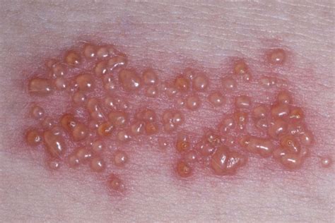 Shingles (Herpes Zoster) as related to Infections - Pictures