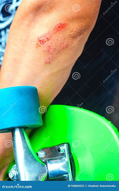 Injuries in extreme sports stock photo. Image of green - 94884552