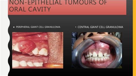 Peripheral and central giant cell granuloma