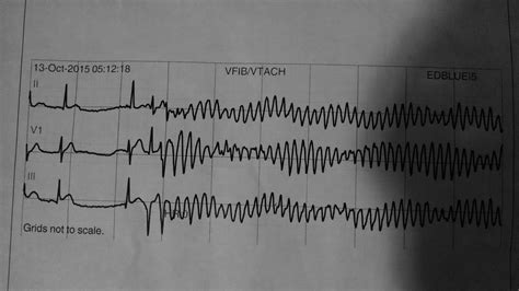 R-on-T Phenomenon in an Acute MI Patient. : r/EKGs