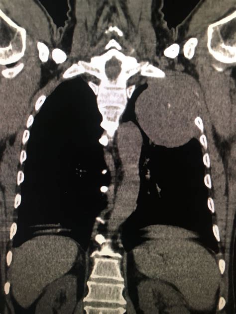 Radiology Imaging, Rad Tech, Ct Scan, Lungs, Tumor, X Ray, Cases ...