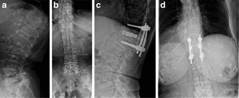 Radiographs of Patient 10 in Group I show a T12 vertebral compression... | Download Scientific ...