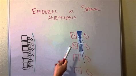 Spinal Block Versus Epidural Block - Anesthesia | Faculty of Medicine