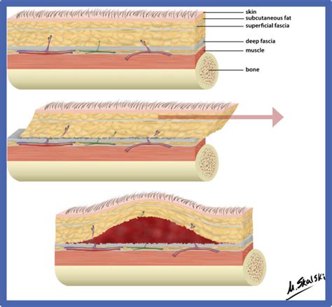 Morel-Lavallee Lesions - Diagnosis and practical management of these troublesome injuries ...