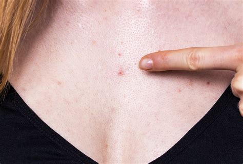 Chest Acne: Causes & 5 Ways to Get Rid of It - eMediHealth