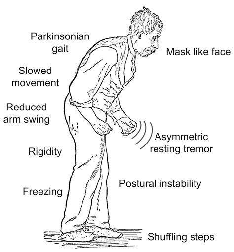 Parkinson's: four unusual signs you may be at risk