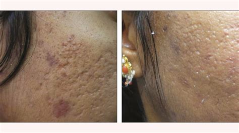 Demystifying Laser Skin Resurfacing: A Before and After Tale of Transformation