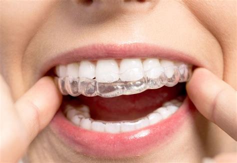 The Benefits of Dental Splints