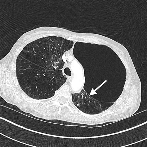 Cureus | Vanishing Lung Syndrome: An Idiopathic Bullous Emphysema Mimicking Pneumothorax