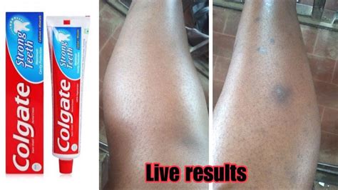 HOW TO:REMOVE DARK SPOTS FROM YOUR LEGS FAST,100% WORKING - YouTube | Remove dark spots, Dark ...