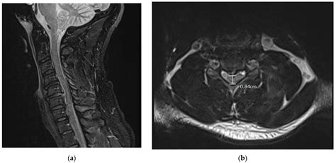 Lumbar Spine Mri Bulging Disc