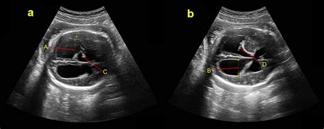 Fetal Hydrocephalus Ultrasound