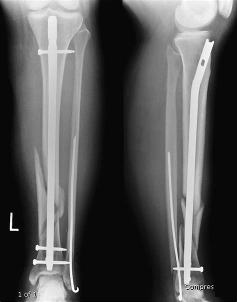 1 – Radiologic Guide to Orthopedic Devices and Miscellaneous Foreign Bodies | Radiology Key