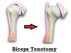 Biceps Tendonitis: Causes, Symptoms & Treatment