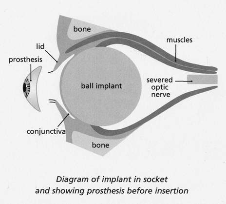 Prosthetic Eye for Evisceration