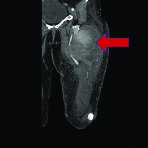 Aortogram with bilateral pelvic runoff demonstrated beads on a string... | Download Scientific ...