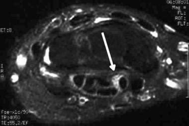 Carpal Tunnel Syndrome Imaging: Practice Essentials, Radiography ...