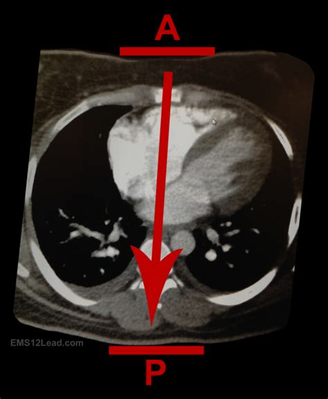 Transcutaneous Pacing Success!!! (Part 2)