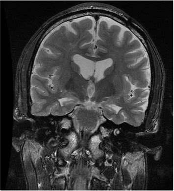 Coronal T2 MRI showing bilateral left > right hippocampal atrophy.