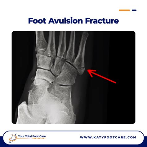 Foot Avulsion Fractures: Causes, Symptoms & Treatment | YTFCS