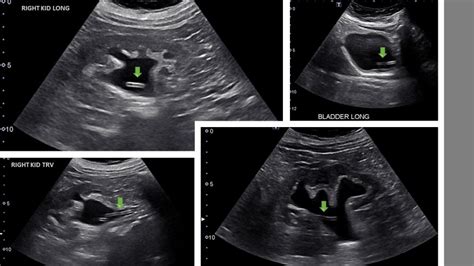 Sonographic appearance of an ureteral stent – NephroPOCUS