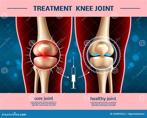 Realistic Knee Joints. Osteoarthritis Treatment, Anti Inflammatory ...