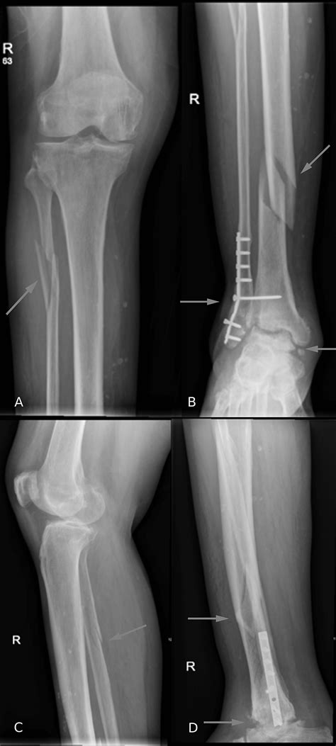 Cureus | Simultaneous Surgical Management of Acute Tibial Shaft Fracture and Post-traumatic ...